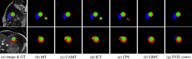 Figure 4 for EVIL: Evidential Inference Learning for Trustworthy Semi-supervised Medical Image Segmentation