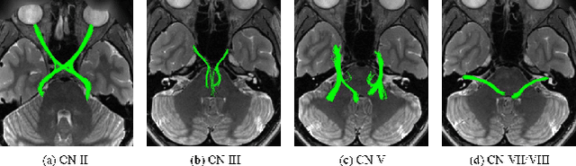 Figure 4 for Anatomy-guided fiber trajectory distribution estimation for cranial nerves tractography