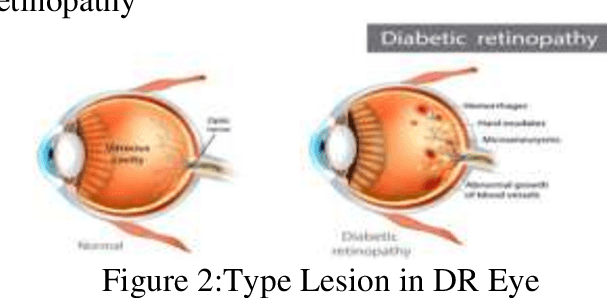 Figure 2 for Diagnosis of diabetic retinopathy using machine learning & deep learning technique