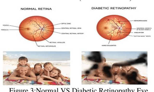 Figure 3 for Diagnosis of diabetic retinopathy using machine learning & deep learning technique