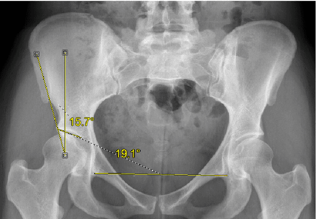 Figure 1 for Gaussian Process Diffeomorphic Statistical Shape Modelling Outperforms Angle-Based Methods for Assessment of Hip Dysplasia