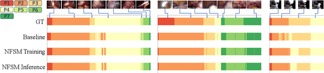 Figure 4 for Neural Finite-State Machines for Surgical Phase Recognition