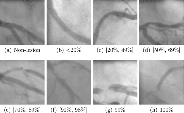 Figure 1 for Coronary Artery Disease Classification with Different Lesion Degree Ranges based on Deep Learning