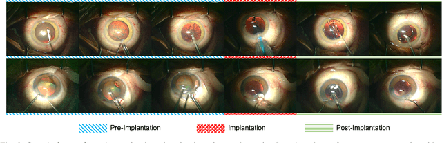 Figure 2 for Predicting Postoperative Intraocular Lens Dislocation in Cataract Surgery via Deep Learning