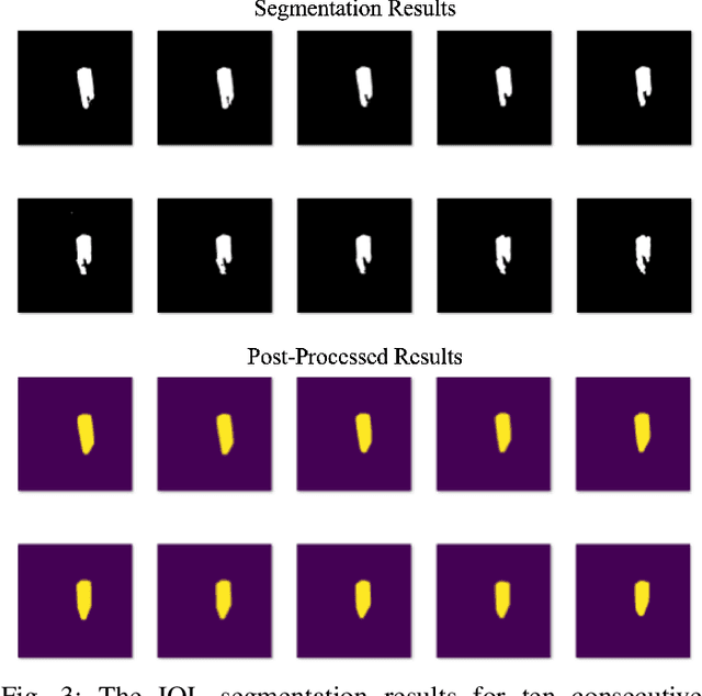 Figure 3 for Predicting Postoperative Intraocular Lens Dislocation in Cataract Surgery via Deep Learning