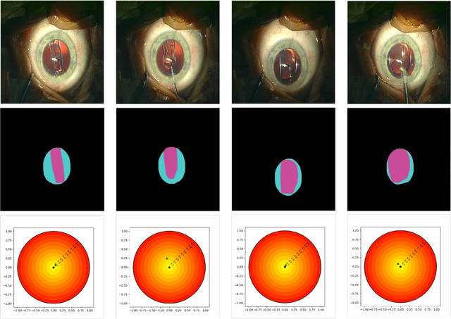 Figure 4 for Predicting Postoperative Intraocular Lens Dislocation in Cataract Surgery via Deep Learning