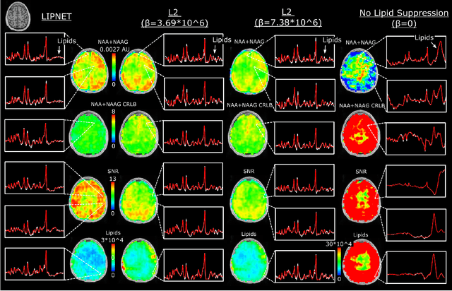 Figure 4 for WALINET: A water and lipid identification convolutional Neural Network for nuisance signal removal in 1H MR Spectroscopic Imaging