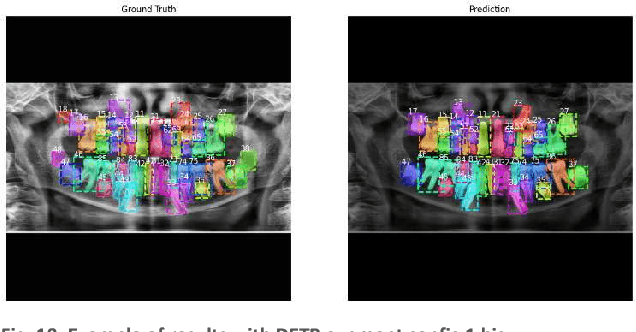 Figure 2 for Detection Transformer for Teeth Detection, Segmentation, and Numbering in Oral Rare Diseases: Focus on Data Augmentation and Inpainting Techniques