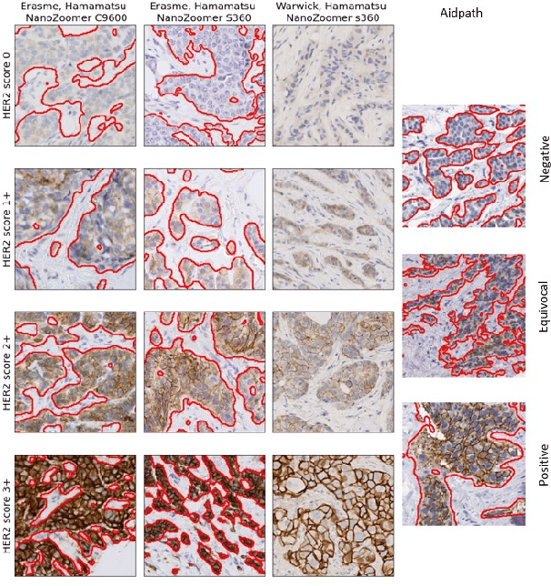 Figure 3 for Interpretable HER2 scoring by evaluating clinical Guidelines through a weakly supervised, constrained Deep Learning Approach