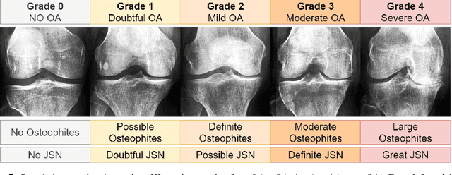 Figure 3 for Exploring the Efficacy of Base Data Augmentation Methods in Deep Learning-Based Radiograph Classification of Knee Joint Osteoarthritis