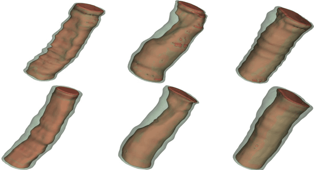 Figure 2 for Automatic Diagnosis of Carotid Atherosclerosis Using a Portable Freehand 3D Ultrasound Imaging System