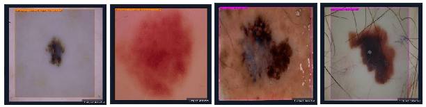 Figure 4 for Derm-T2IM: Harnessing Synthetic Skin Lesion Data via Stable Diffusion Models for Enhanced Skin Disease Classification using ViT and CNN