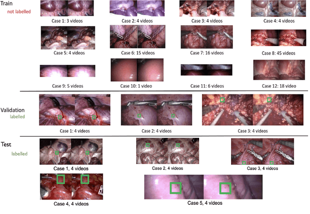 Figure 1 for SurgT challenge: Benchmark of Soft-Tissue Trackers for Robotic Surgery