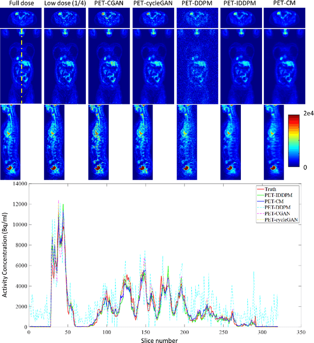 Figure 4 for Full-dose PET Synthesis from Low-dose PET Using High-efficiency Diffusion Denoising Probabilistic Model