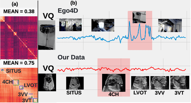 Figure 1 for MCAT: Visual Query-Based Localization of Standard Anatomical Clips in Fetal Ultrasound Videos Using Multi-Tier Class-Aware Token Transformer