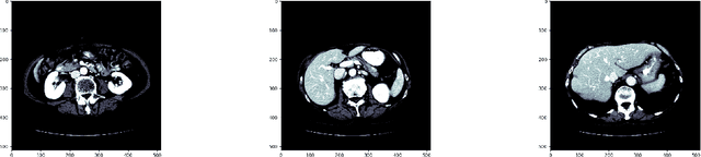 Figure 3 for ProKAN: Progressive Stacking of Kolmogorov-Arnold Networks for Efficient Liver Segmentation