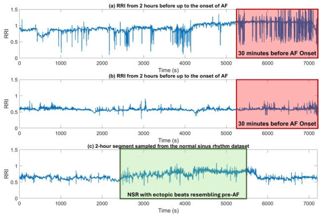Figure 1 for Atrial Fibrillation Prediction Using a Lightweight Temporal Convolutional and Selective State Space Architecture