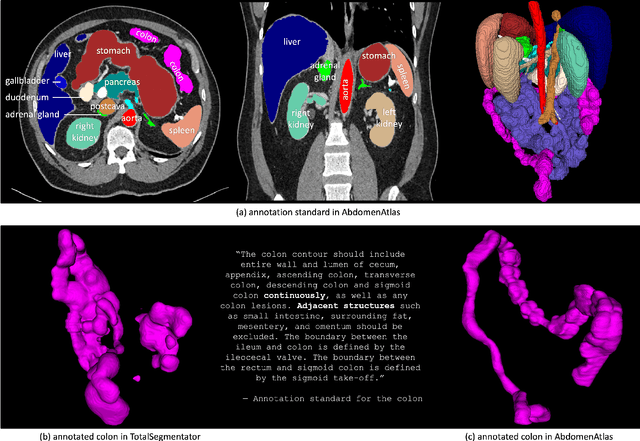 Figure 4 for AbdomenAtlas: A Large-Scale, Detailed-Annotated, & Multi-Center Dataset for Efficient Transfer Learning and Open Algorithmic Benchmarking