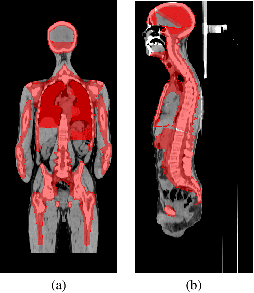 Figure 1 for Segmentation of Planning Target Volume in CT Series for Total Marrow Irradiation Using U-Net