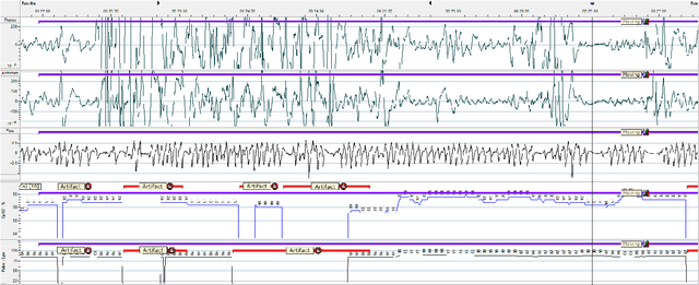 Figure 3 for AIOSA: An approach to the automatic identification of obstructive sleep apnea events based on deep learning