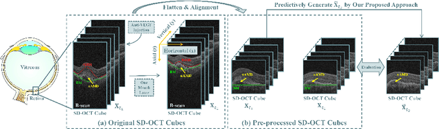 Figure 1 for Learn Single-horizon Disease Evolution for Predictive Generation of Post-therapeutic Neovascular Age-related Macular Degeneration