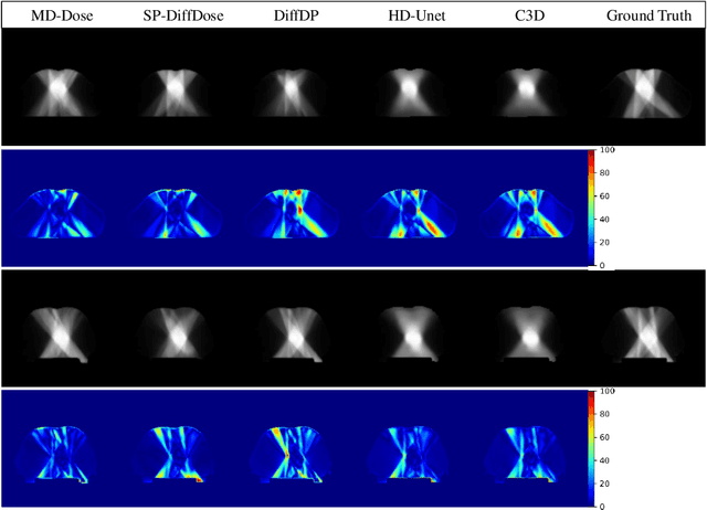 Figure 3 for MD-Dose: A Diffusion Model based on the Mamba for Radiotherapy Dose Prediction