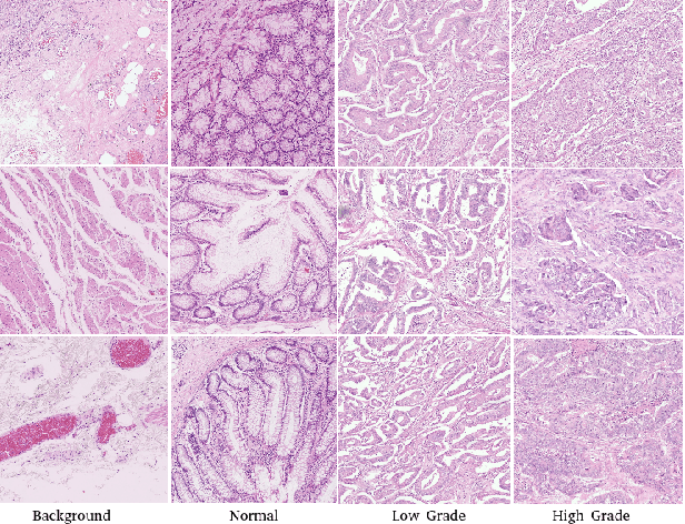 Figure 3 for DeepFEL: Deep Fastfood Ensemble Learning for Histopathology Image Analysis