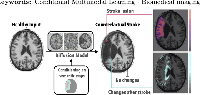 Figure 1 for MedEdit: Counterfactual Diffusion-based Image Editing on Brain MRI