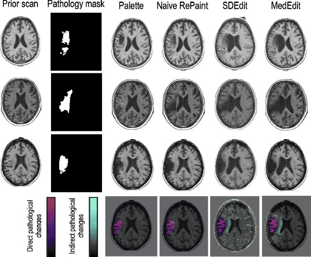 Figure 3 for MedEdit: Counterfactual Diffusion-based Image Editing on Brain MRI