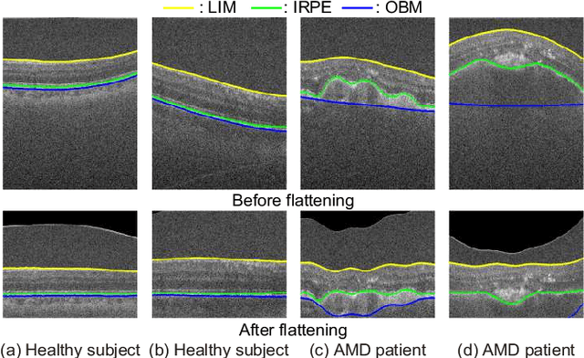 Figure 1 for Formula-Driven Data Augmentation and Partial Retinal Layer Copying for Retinal Layer Segmentation