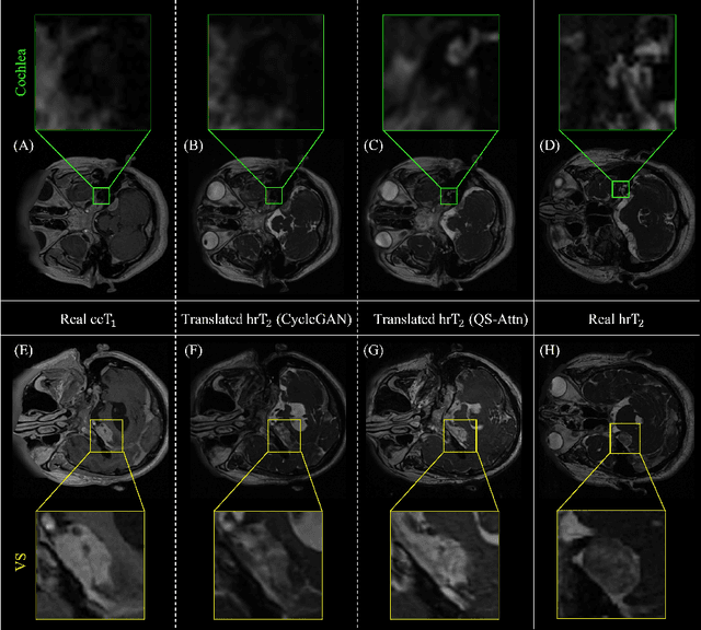 Figure 4 for Multi-view Cross-Modality MR Image Translation for Vestibular Schwannoma and Cochlea Segmentation