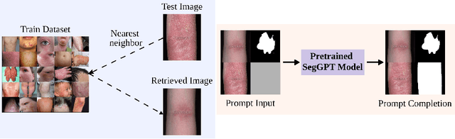 Figure 1 for Visual In-Context Learning for Few-Shot Eczema Segmentation