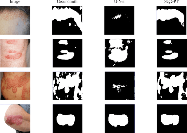 Figure 3 for Visual In-Context Learning for Few-Shot Eczema Segmentation