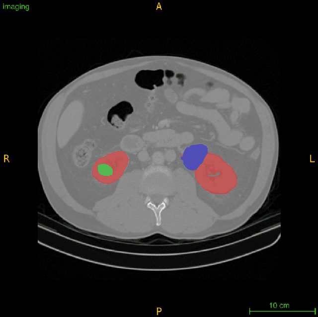 Figure 1 for Automated 3D Segmentation of Kidneys and Tumors in MICCAI KiTS 2023 Challenge