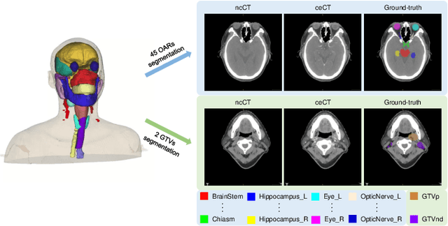 Figure 1 for SegRap2023: A Benchmark of Organs-at-Risk and Gross Tumor Volume Segmentation for Radiotherapy Planning of Nasopharyngeal Carcinoma