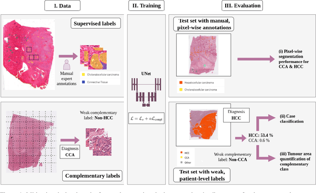 Figure 1 for Leveraging weak complementary labels to improve semantic segmentation of hepatocellular carcinoma and cholangiocarcinoma in H&E-stained slides