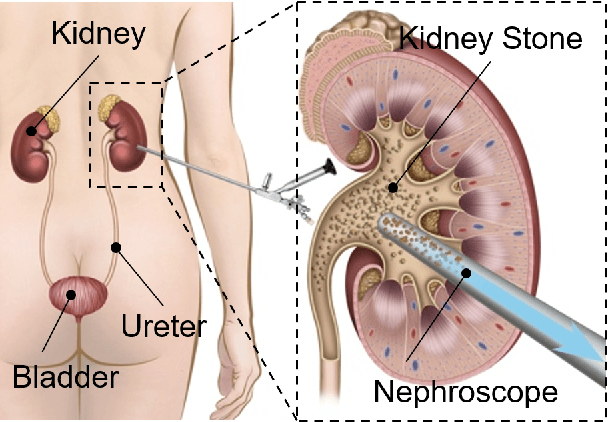 Figure 1 for Augmented Reality and Human-Robot Collaboration Framework for Percutaneous Nephrolithotomy