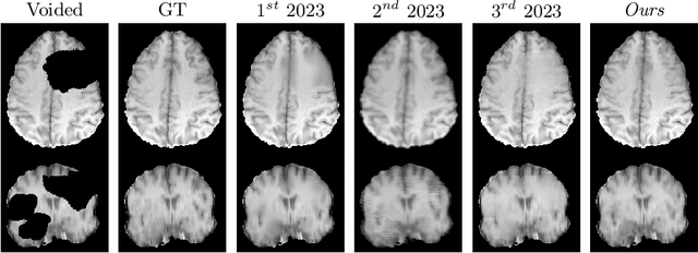 Figure 3 for fastWDM3D: Fast and Accurate 3D Healthy Tissue Inpainting
