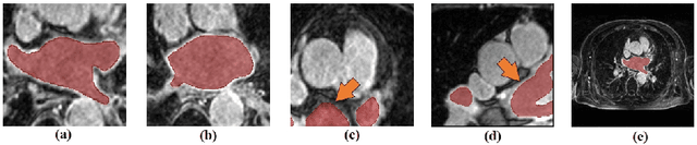 Figure 1 for Dynamic Position Transformation and Boundary Refinement Network for Left Atrial Segmentation