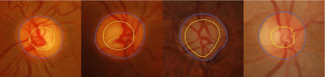 Figure 3 for Automatic detection of glaucoma via fundus imaging and artificial intelligence: A review