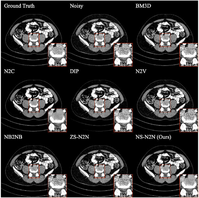 Figure 4 for Neighboring Slice Noise2Noise: Self-Supervised Medical Image Denoising from Single Noisy Image Volume