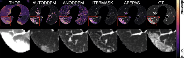 Figure 3 for AREPAS: Anomaly Detection in Fine-Grained Anatomy with Reconstruction-Based Semantic Patch-Scoring