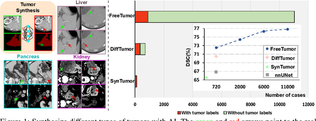 Figure 1 for FreeTumor: Advance Tumor Segmentation via Large-Scale Tumor Synthesis