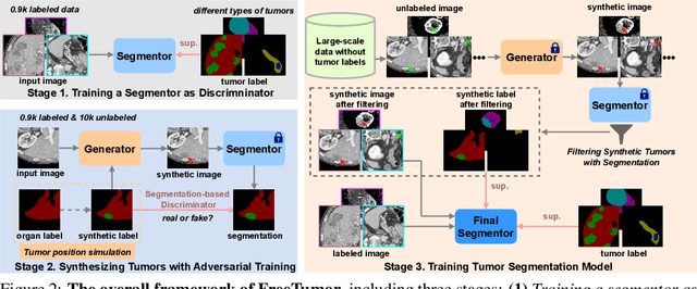 Figure 3 for FreeTumor: Advance Tumor Segmentation via Large-Scale Tumor Synthesis