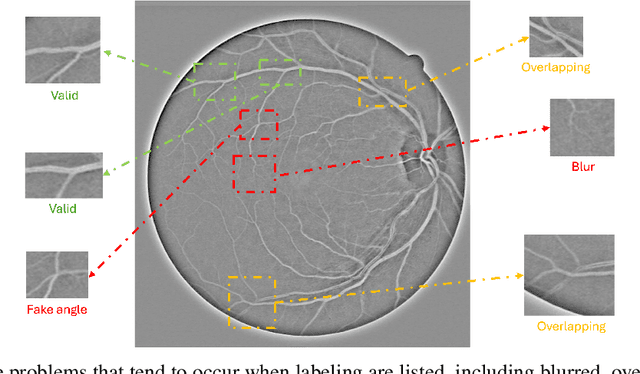 Figure 4 for RBAD: A Dataset and Benchmark for Retinal Vessels Branching Angle Detection