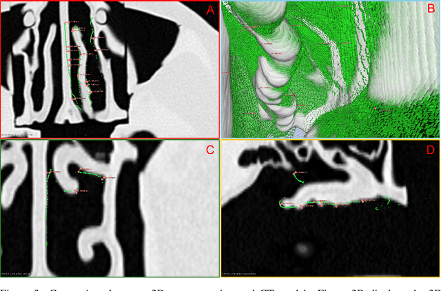 Figure 4 for Hybrid NeRF-Stereo Vision: Pioneering Depth Estimation and 3D Reconstruction in Endoscopy