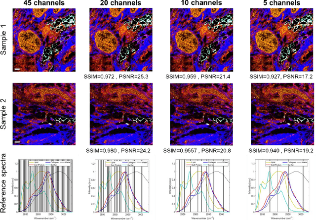 Figure 3 for High-content stimulated Raman histology of human breast cancer