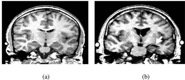 Figure 1 for Lightweight 3D Convolutional Neural Network for Schizophrenia diagnosis using MRI Images and Ensemble Bagging Classifier