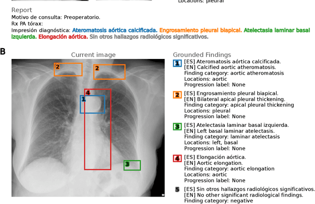 Figure 1 for PadChest-GR: A Bilingual Chest X-ray Dataset for Grounded Radiology Report Generation