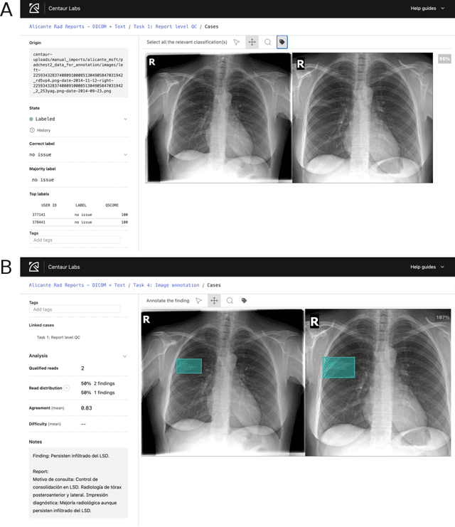 Figure 3 for PadChest-GR: A Bilingual Chest X-ray Dataset for Grounded Radiology Report Generation